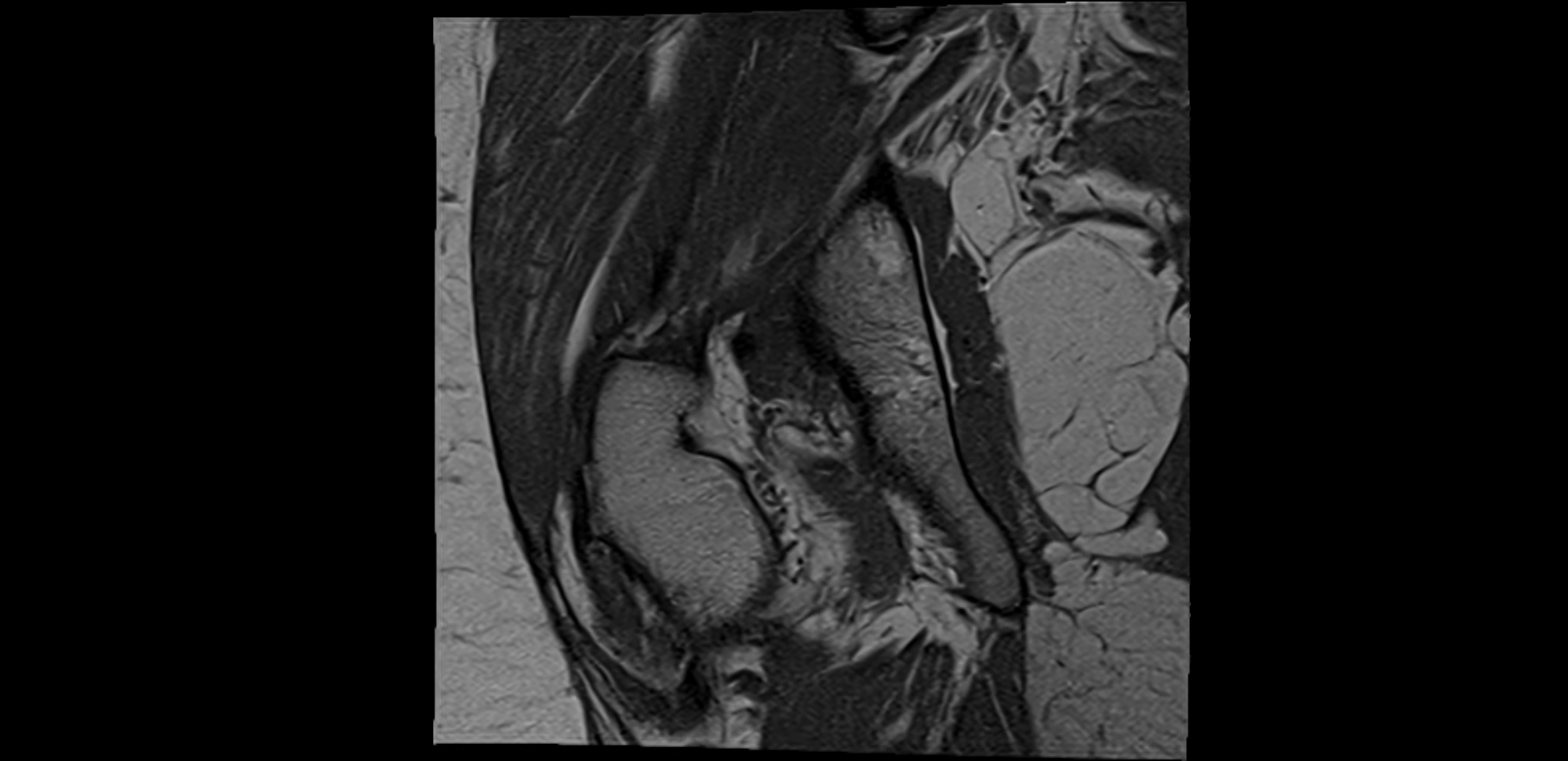 MRI Hip ligaments coronal cross sectional anatomy 3T  radiology  image-img-00001-00021.webp